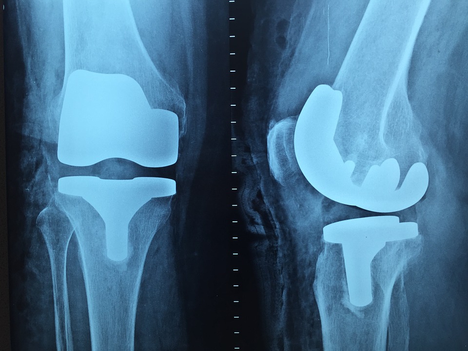 knee bone